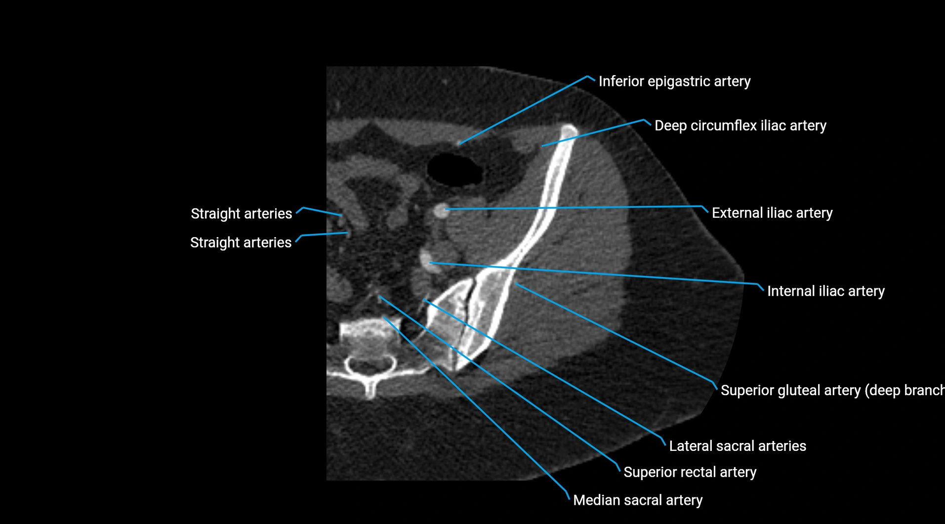 CTA lower limb cross sectional anatomy labelled image _28.webp